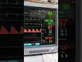 Download Lagu Cardiac Monitor for ICU patients 🌟 Biomed dude #shorts #heartrate #pulse #icu #nursing #biomedical