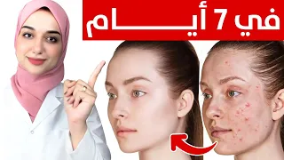 علاج حبوب الوجه و الجسم في أسبوع حب الشباب و علاجه السريع و الاقتصادى 