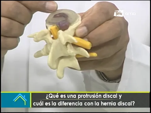¿Qué es una protrusión discal y cuál es la diferencia con la hernia discal?