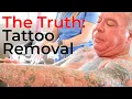 The Truth Behind Laser Tattoo Removal