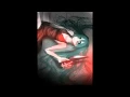 Download Lagu Nightcore Anti - Heart Beat [Yandere Miku]