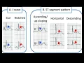 High risk features of Benign early repolarization pattern on ECG
