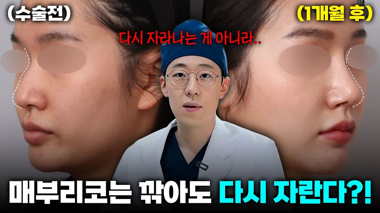 매부리 코는 깎아도 다시 자란다?? #매부리코