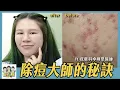 Download Lagu 【綜口味】痘痘一直治不好？醫師曝5大日常NG行為：90%人都不知道！#綜口味開房間 EP.850