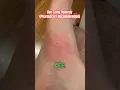 BEE STINGS 101