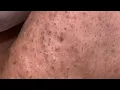 Ultimate ASMR Deep Pore Cleansing and Blackhead Removal in Spa Facial Game