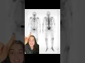 Nuclear Medicine Exams Explained Whole Body Bone Scan