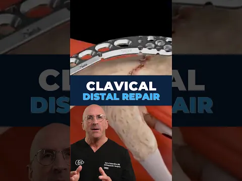 Why Some Collarbone Fractures Will Not Heal on Their Own