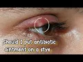 Should I put antibiotic ointment on a stye