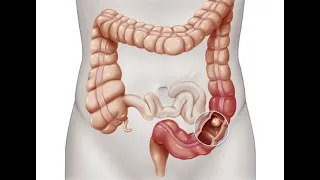 اشهر اماكن الاورام فى القولون دكتور علي احمد شفيق 