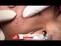EP 50 FAST AND EFFECTIVE BLACKHEAD AND WHITEHEAD SQUEEZING ACNE SQUEEZING FAST EFFECTIVE