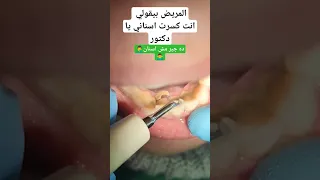 ما هي اضرار جير الاسنان Plaque Formation On Teeth 