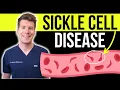 Doctor explains SICKLE CELL DISEASE Causes symptoms and treatment