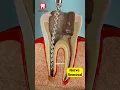Download Lagu Root Canal Treatment 3D Animation #shorts