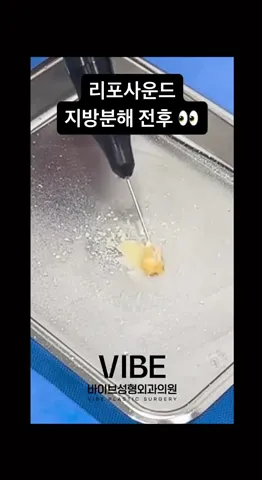 지방 분해 과정🔎 직접 보여드릴게요! 👀 | 초음파지방흡입 | 리포사운드(엘싸 LSSA | 얼굴지방흡입 | 이중턱지방흡입