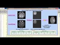 Medical Image Fusion using Wavelet Transform Matlab Project Source Code Image Fusion Using DWT
