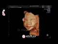 Download Lagu Mimics of the fetus in the womb. Amazing 4D ultrasound video!- Dr. Kağan Kocatepe