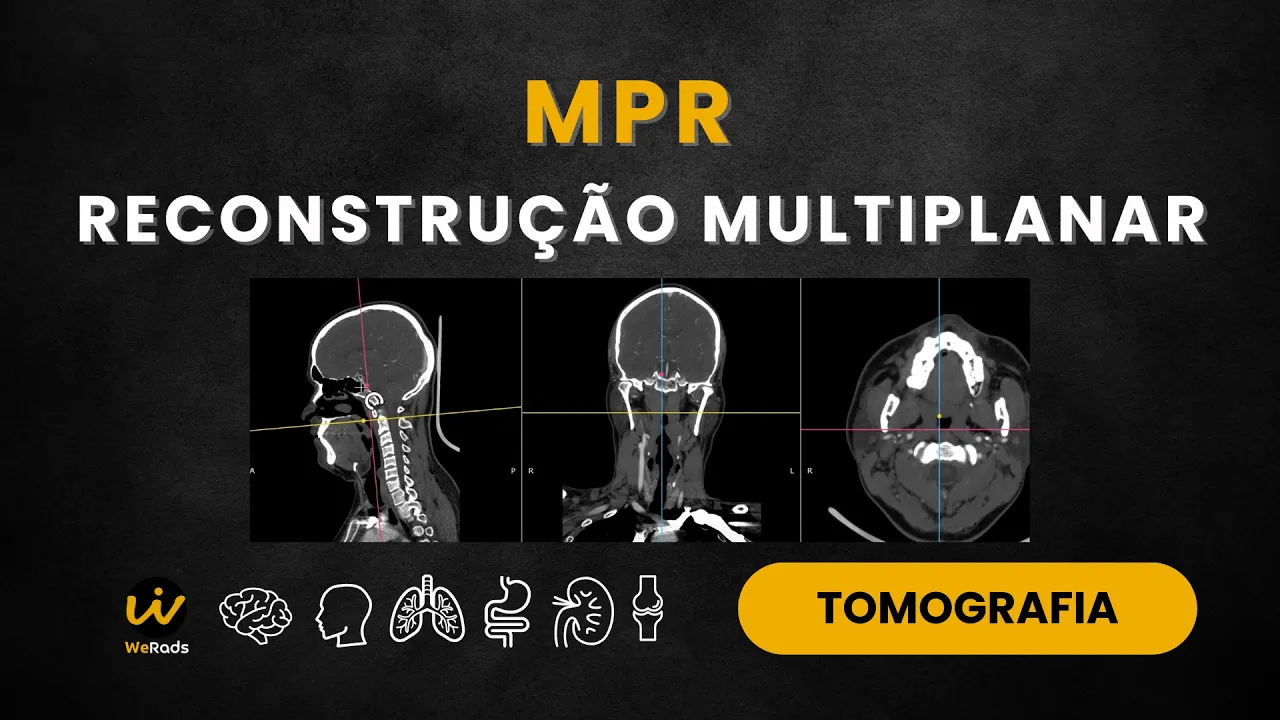 MPR - RECONSTRUÇÃO MULTIPLANAR NA TOMOGRAFIA - O QUE É E COMO FAZER