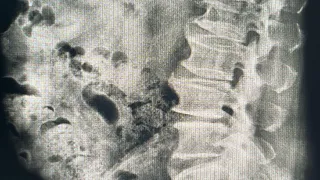  ทำไมคนหนุ่มที่มีอาการปวดหลังและชาลงขาถึงเจ็บมากกว่าคนอายุมาก 