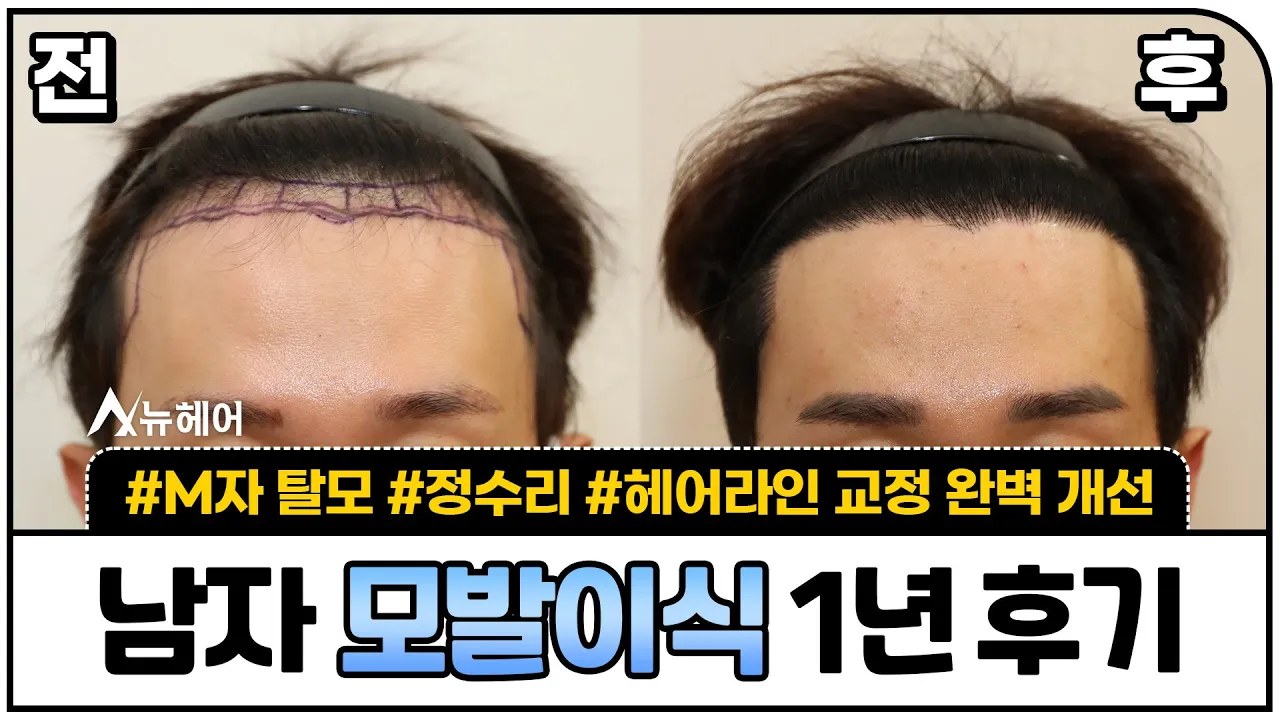 모발이식 후기! 1년 후 깜짝 놀랍니다ㅣ1500모낭 ~ 1600모낭ㅣ뉴헤어