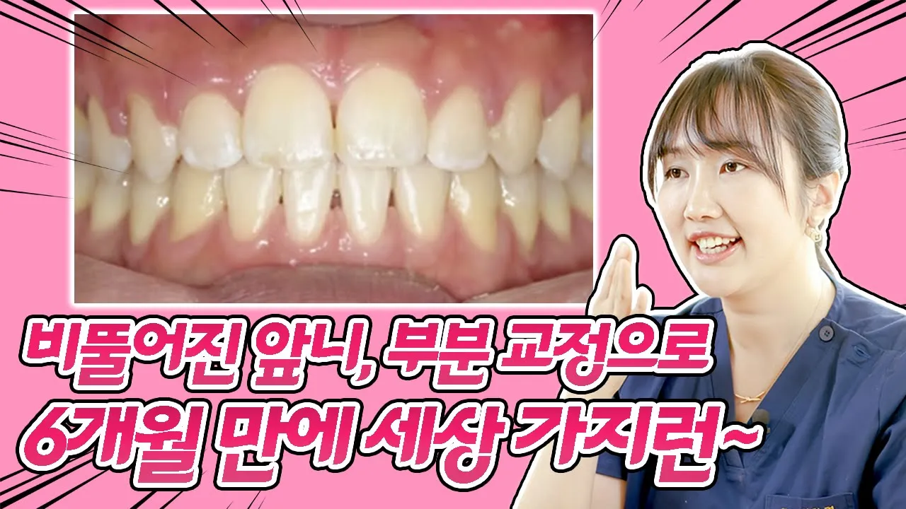 "6개월이면 됩니다" 부분 교정으로 울퉁불퉁 앞니가 세상 매끈해짐! #부분교정 #교정비용 #교정사례 #앞니교정 #덧니교정 I 스마일뷰치과 러블리 김원장