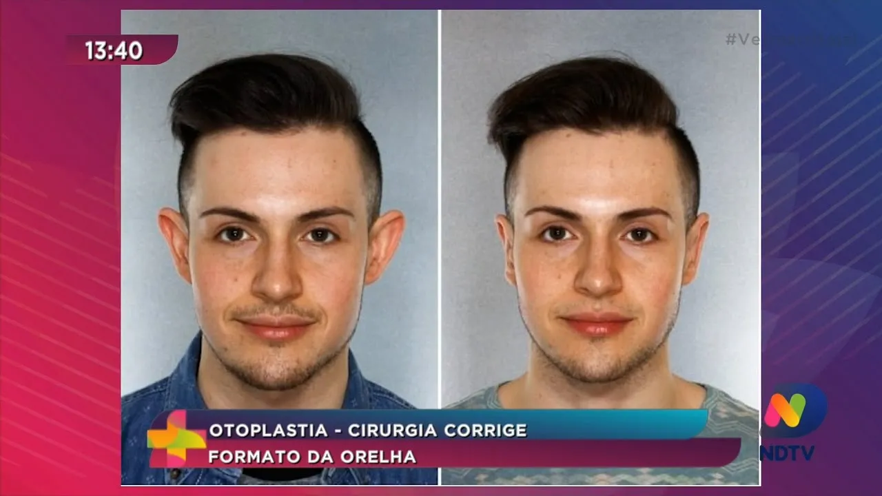 Otoplastia: cirurgia corrige formato da orelha