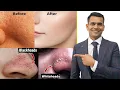 Blackheads Whiteheads Open Pores 100 Working Home Remedy How To Shrink Pores