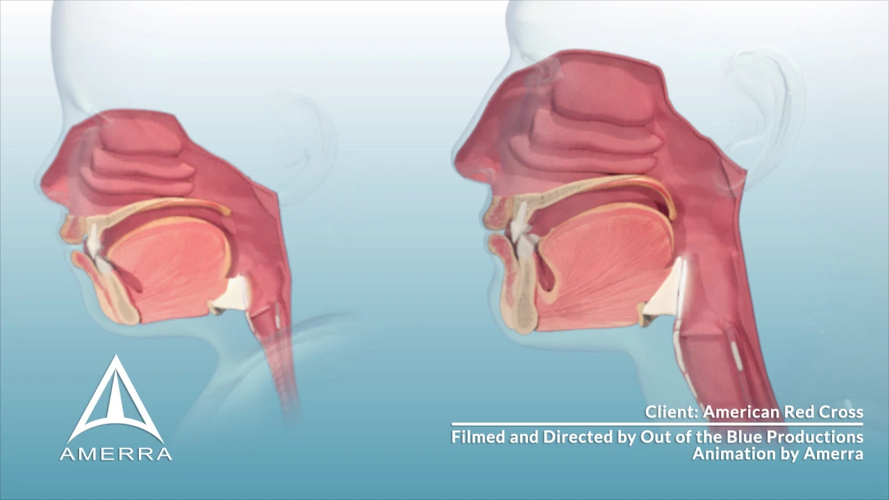 Composite Airway Access Segments - 3D Medical Animation