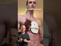 Pigeon Chest Deformity