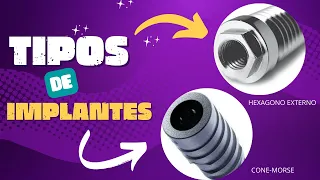 TIPOS DE IMPLANTE DENTÁRIO - HEXÁGONO EXTERNO x CONE-MORSE