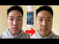 DOES MINOXIDIL CAUSE SKIN AGING AND WRINKLES