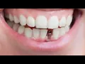 5 Surprising Facts About Implants
