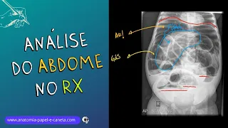 Aprenda a analisar o exame de ABDOME no RX