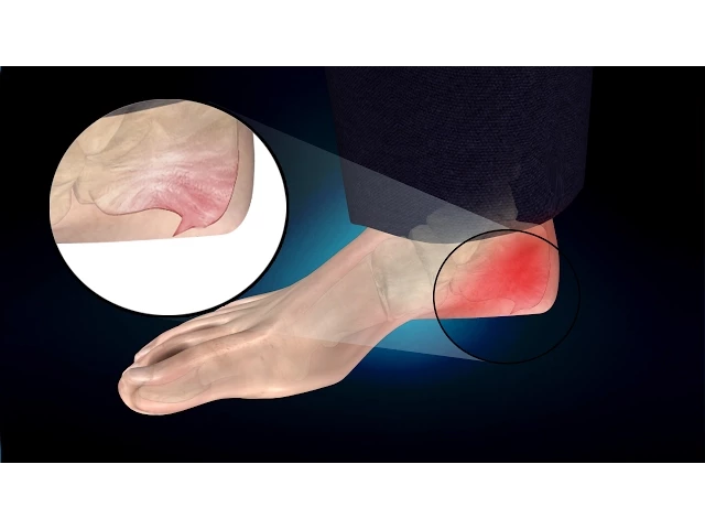 Heel Spur or Calcaneal Spur: Treatment, Causes, Symptoms, Prevention