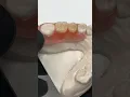 FiberFlex Nesbit partial for Dr Thomas Kaiser in South Dakota