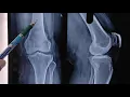 How To Read Knee Joint X Ray Dr Sai Chandra MBBS DNB Ortho