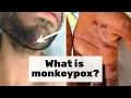 Epidemiologist Answers Common Monkeypox Questions WIRED