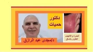 علاج الحمرة والألتهاب الخلوى بالساق Treatment Of Erysipelas And Cellulitis Of The Leg 