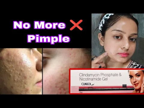Download MP3 #clinsolgel clindamycin phosphate nicotinamide gel review / pimple marks removal cream #clinsolcream