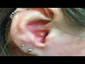Home Remedies for painful pimples in ear