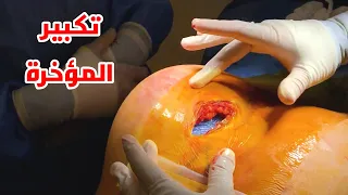 شاهد عملية تكبير المؤخرة Surgical Buttock Augmentation 