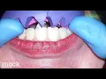 Step by Step Minimally Invasive Veneers Preparation | General Dentist Griya RR