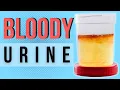 Download Lagu 11 causes for blood in the urine | Hematuria