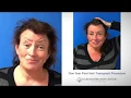Hair Transplant Transgender Patient - 1 Year Case Study