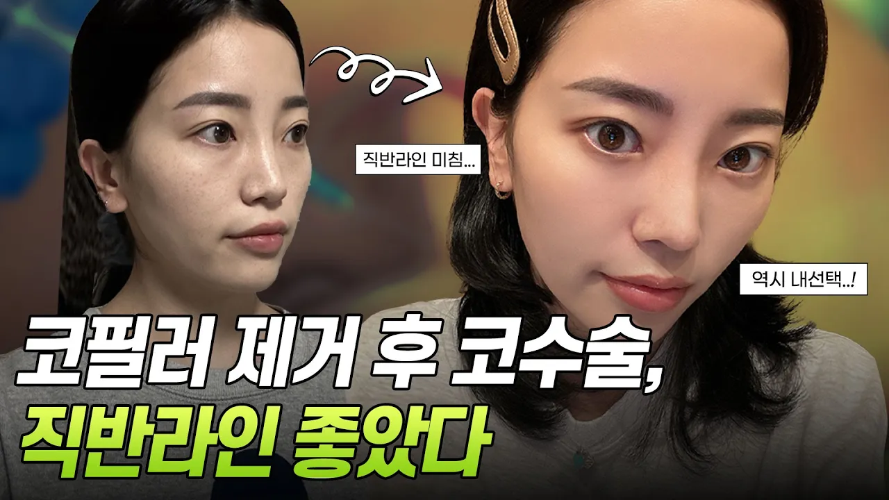 코필러 제거, 에이탑 트리플코성형후기 😍