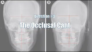 Question 8 The Occlusal Cant