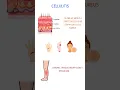 CELLULITIS PATHOPHYSIOLOGY