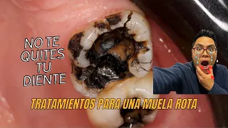 🦷 ¡No te quites un diente! Una muela rota puede recuperarse con el tratamiento adecuado.