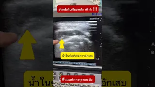  ทำไมคนอายุมากถึงปวดข้อมืออย่างรุนแรงในเวลาไม่กี่ชั่วโมง 