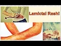Lamictal Rash - Symptoms Treatment